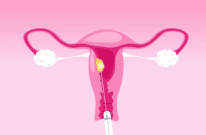 radiofrecuencia para miomas 