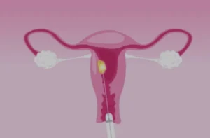 Radiofrecuencia en miomas en Cádiz Radiofrecuencia en Miomas en Granada